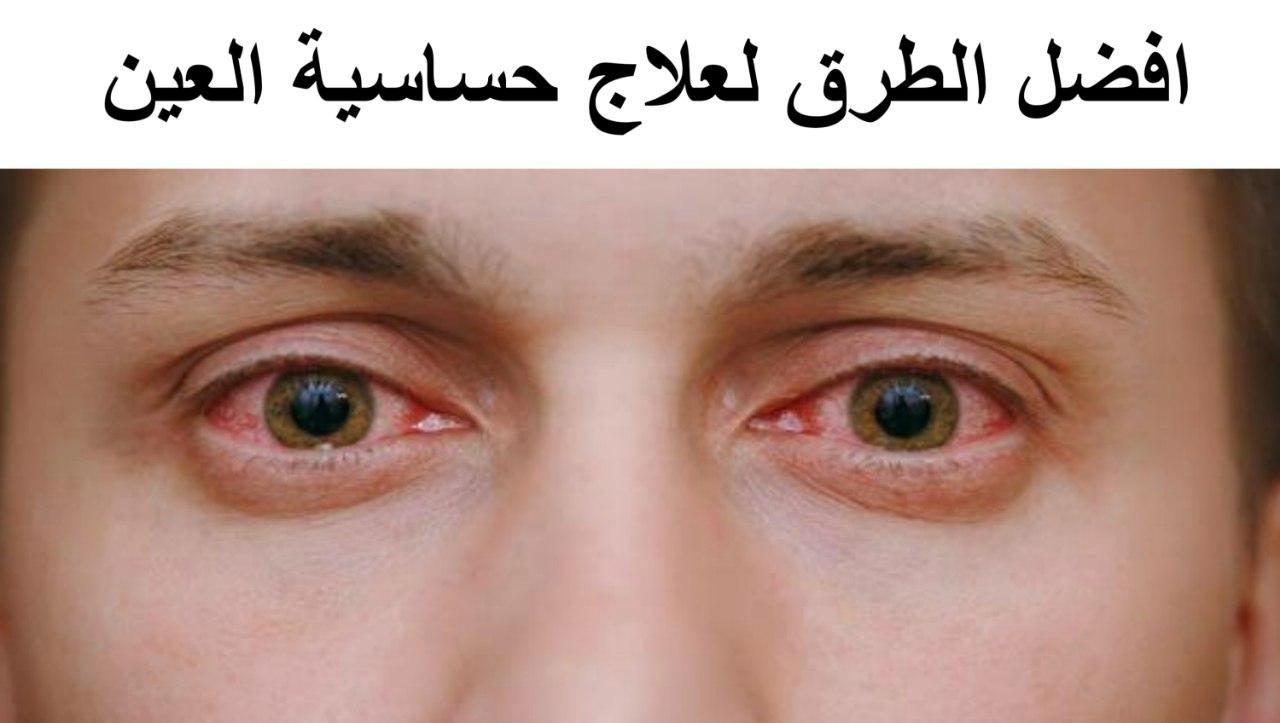 علاج حساسية العين واحمرارها والتخلص من الألم بشكل نهائي
